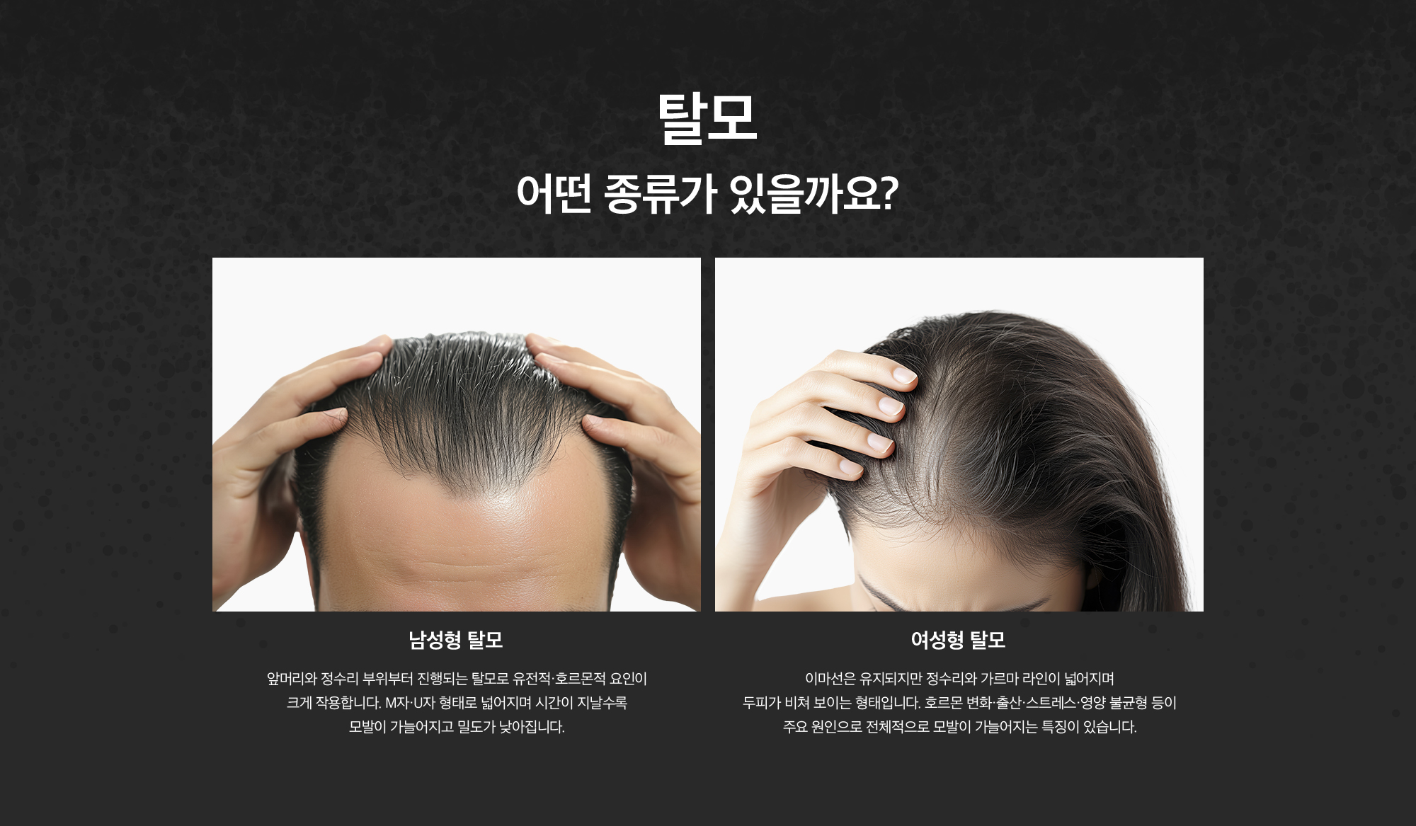 탈모 클리닉