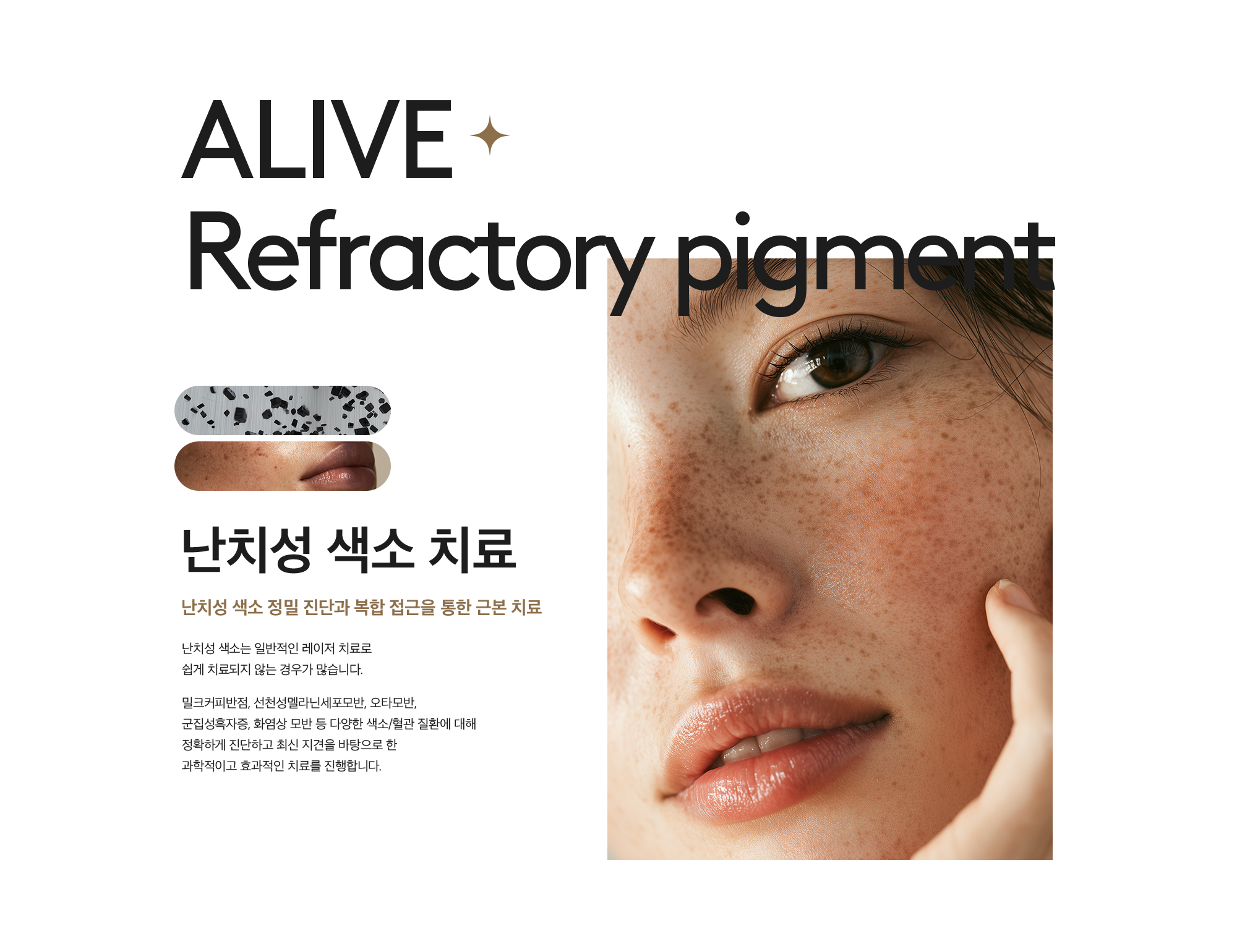 난치성 색소 치료