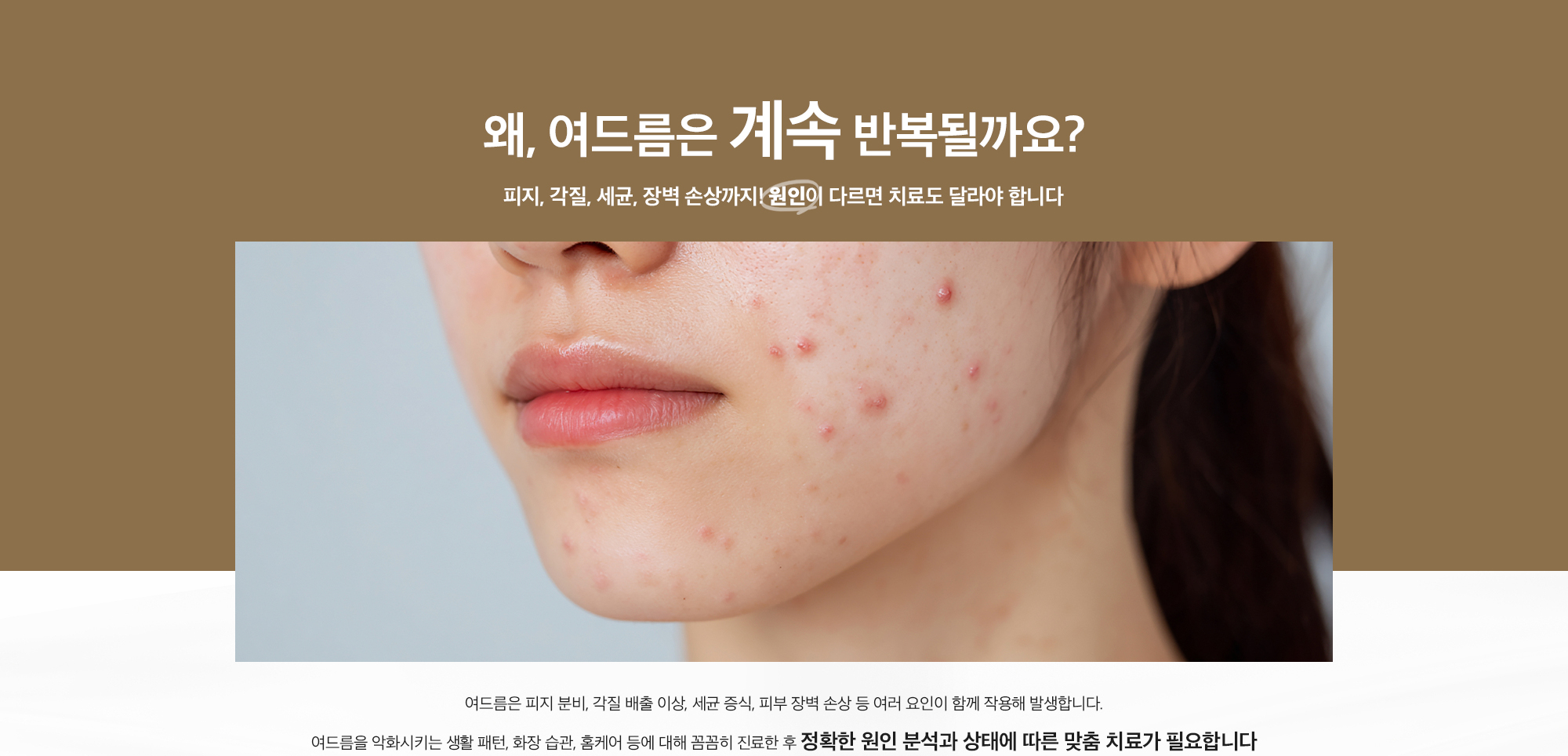 난치성 여드름 치료