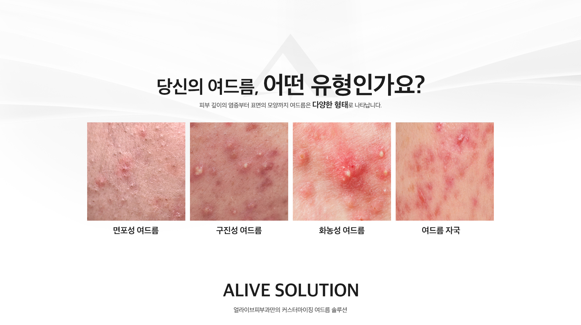 난치성 여드름 치료