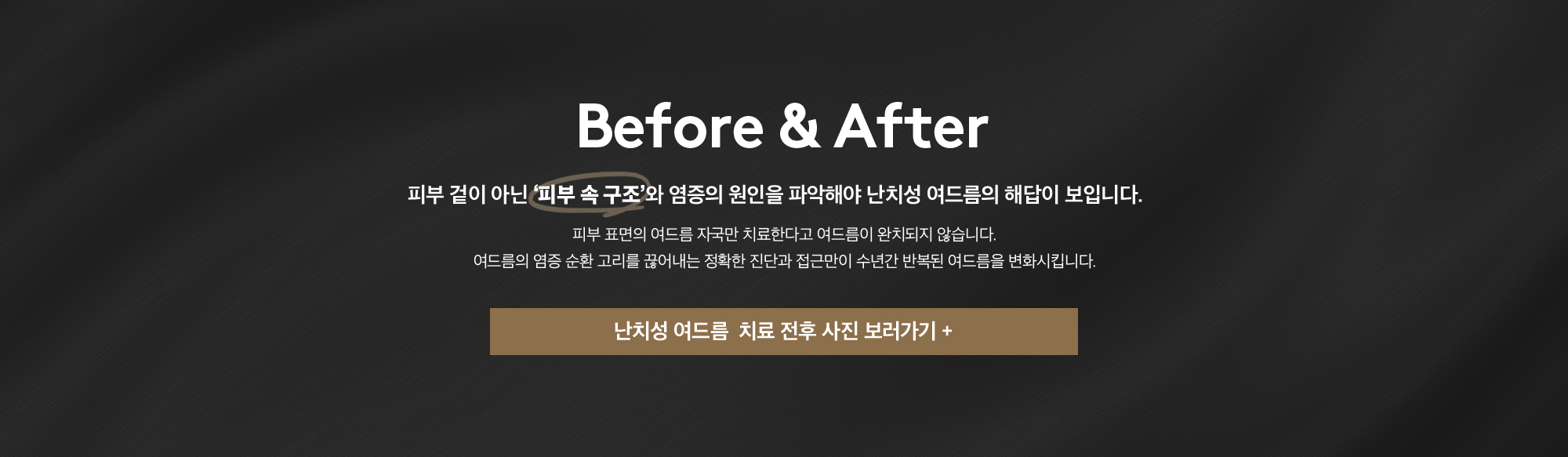 난치성 여드름 치료