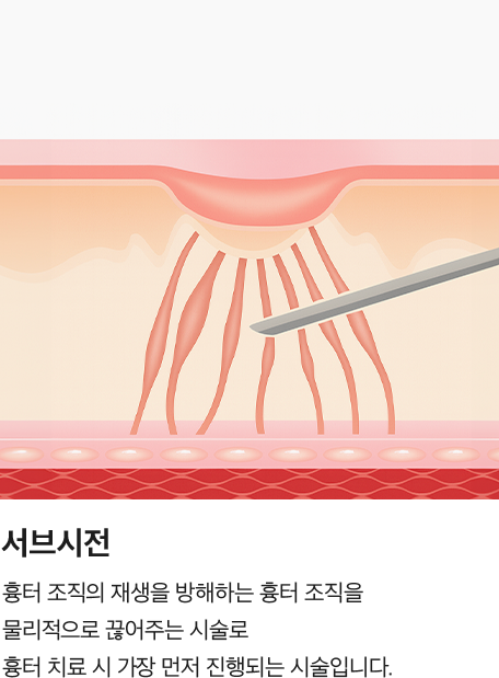 [서브시전] 흉터 조직의 재생을 방해하는 흉터 조직을 물리적으로 끊어주는 시술로 흉터 치료 시 가장 먼저 진행되는 시술입니다.